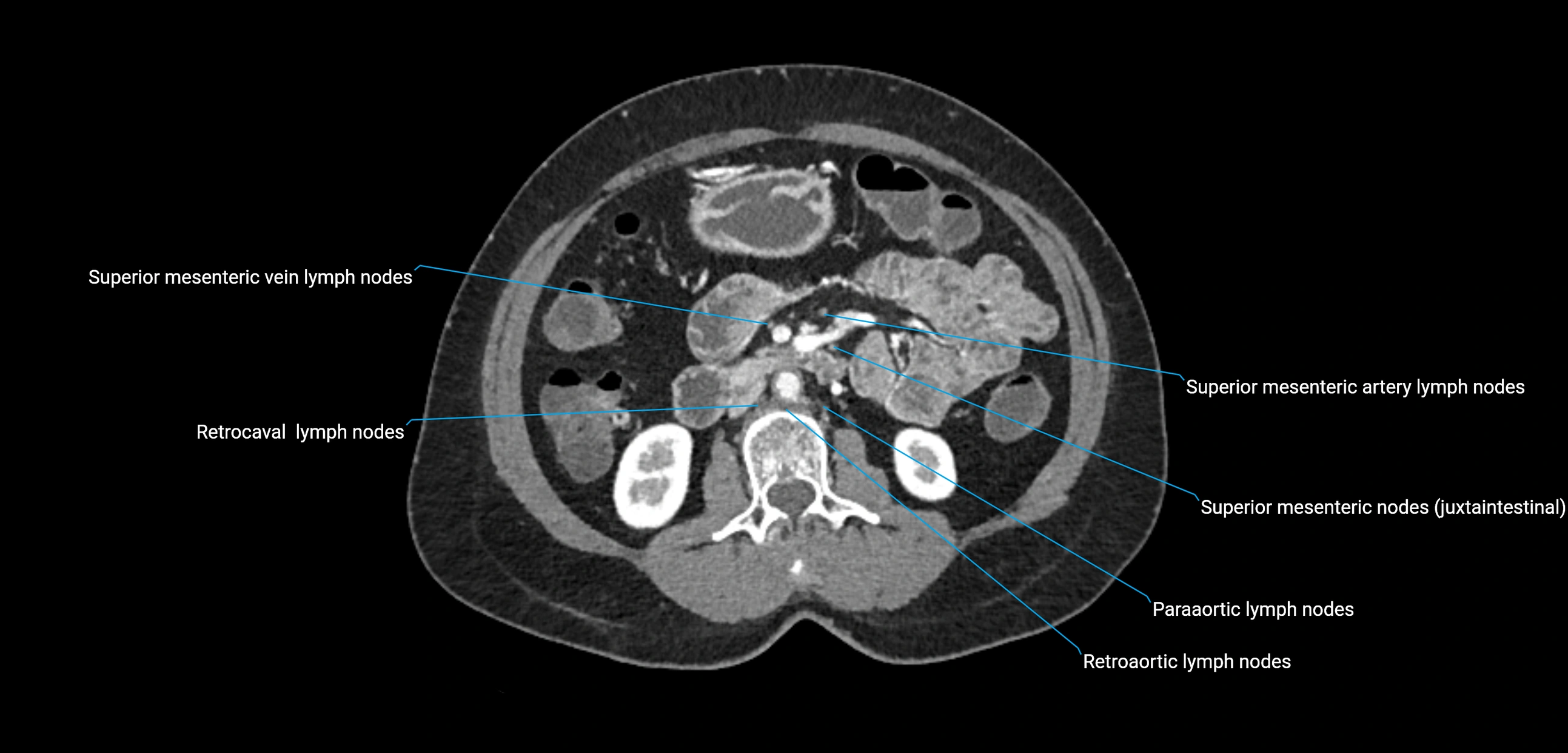 CT ct abdominal lymph nodes  axial cross sectional anatomy  enchanced radiology image -img-00002-00205.webp
